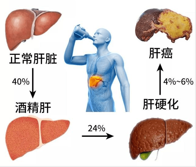 经常喝酒，小心酒精肝！你真的了解吗？